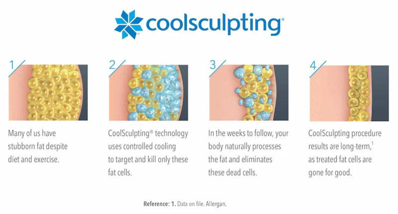 Coolsculpting information | Medical Spa in Menasha, WI